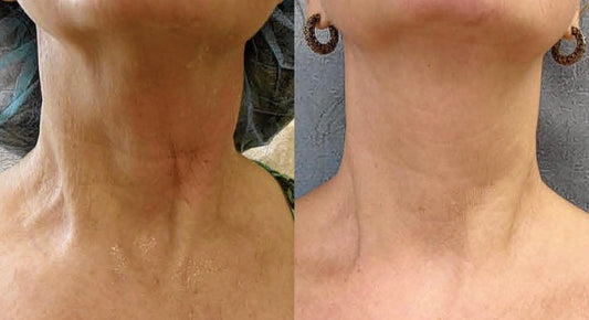 Radio Frequency Before and After Pictures