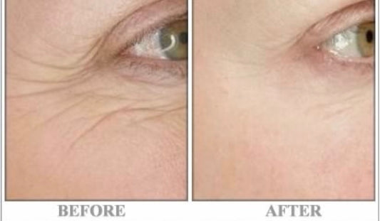 Do At-Home RF Skin Tightening Machines Work?