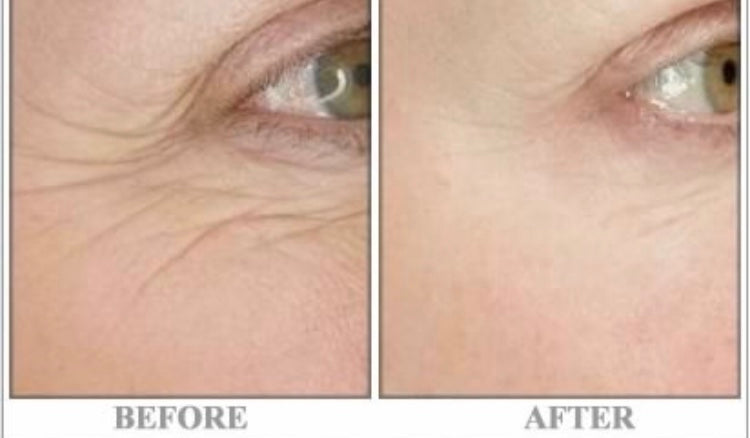 Do At-Home RF Skin Tightening Machines Work?