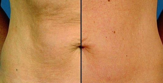 Radio Frequency (RF) Skin Tightening What to Expect